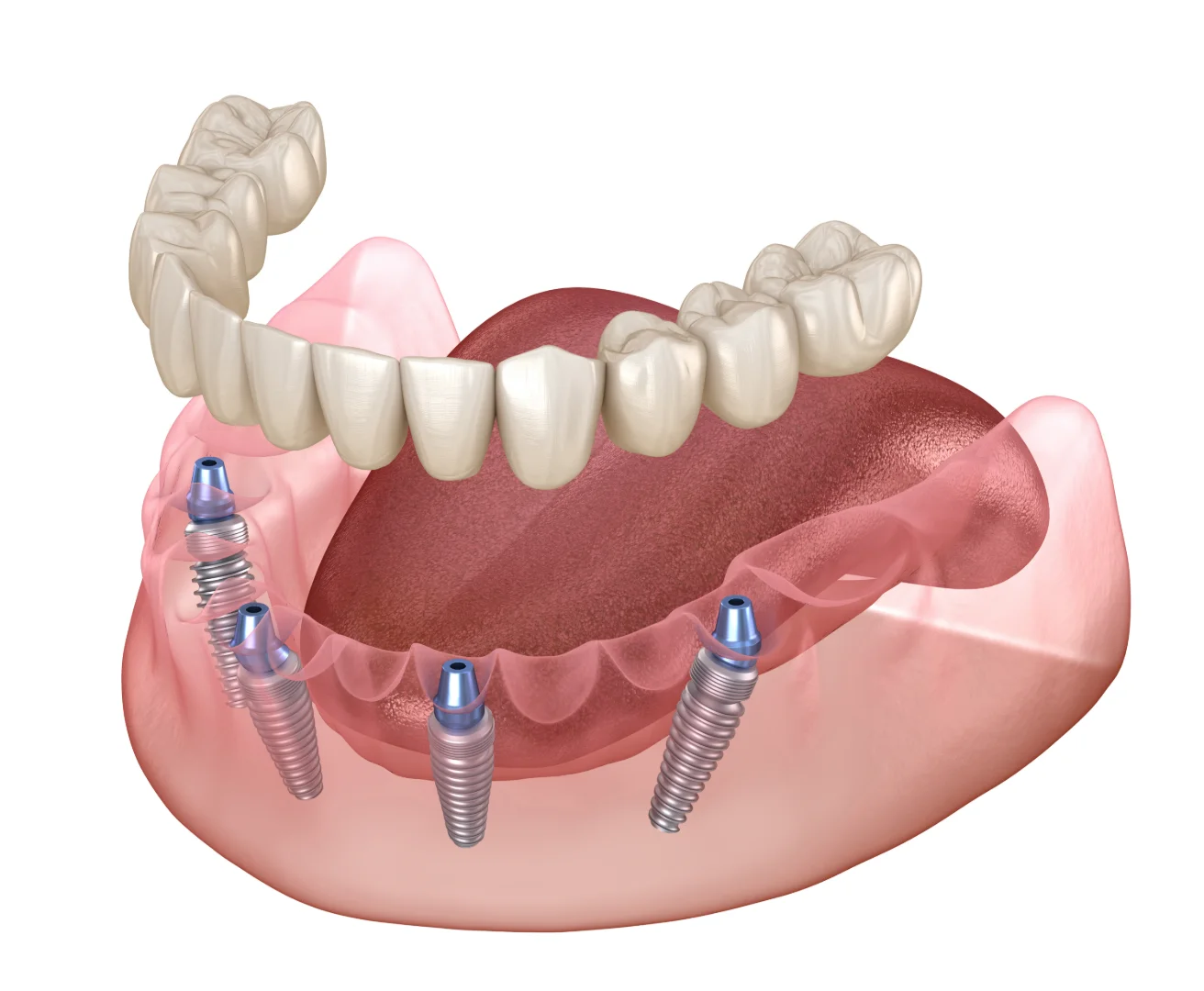 Diagram-style view of a denture anchored to dental implants