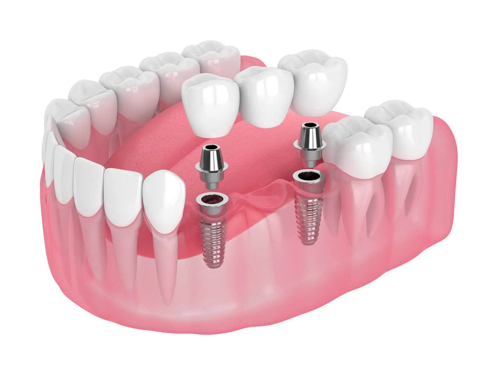 Implant-supported denture that snaps securely onto dental implants